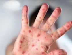 82 Anak di India Terinfeksi Flu Tomat