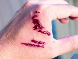 Nenek 81 Tahun di Sikka Digigit Anjing, Kini Tunjukkan Gejala Rabies!